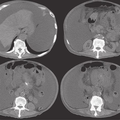 Figure1abdominal Computed Tomography Shows Massive Ascites And A Solid Download Scientific