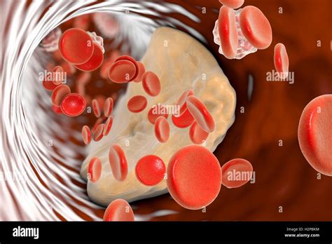 Atheromatous Plaque Inside Blood Vessel Computer Illustration