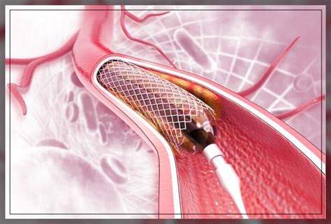 Peripheral Artery Angioplasty Procedure And Stent Placement Engiomed