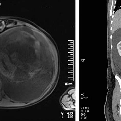 Depicts A Contrast Enhanced Computed Tomographic Scan Revealing