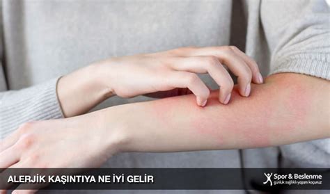 Alerjik Kaşıntıya Ne İyi Gelir Nasıl Geçer Spor ve Beslenme