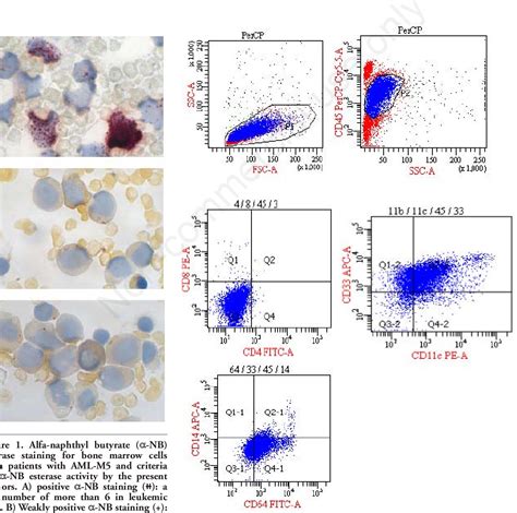 Table 2 From Acute Monocytic Leukemia Diagnosed By Flow Cytometry Includes Acute Myeloid