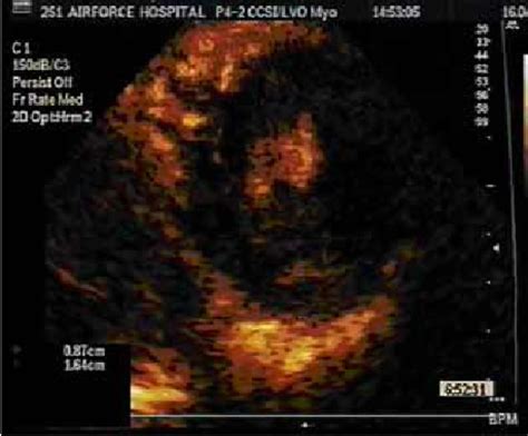 Two Dimensional Echocardiogram Parasternal Short Axis View Of The Left