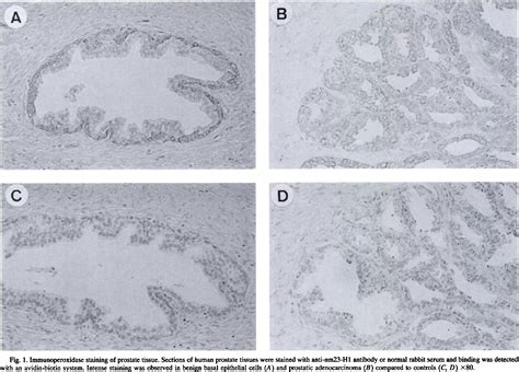 Table 1 From High Levels Of Nm23 Expression Are Related To Cell