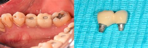 Peri Implant Mucositis And Peri Implantitis Gum Disease Around Dental