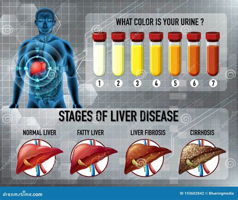 Stages Of Liver Disease Stock Vector Illustration Of Healthy 193602842