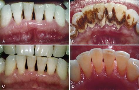 Periodontitis Treatment