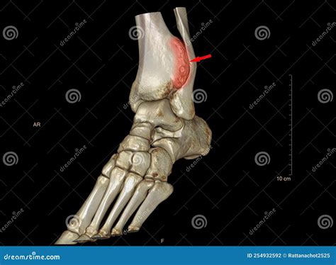 X-ray and Ct Scan 3d Render Images of the Ankle Reveal an Abnormality ...