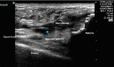 Quadriceps Tendon Ultrasound