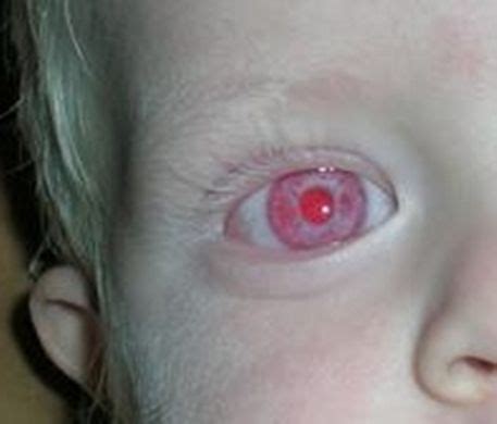 39 best ALBINO EYES [глаза альбиноса] images on Pinterest
