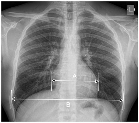 Jcm Free Full Text Radiological Cardiothoracic Ratio In Evidence Based Medicine