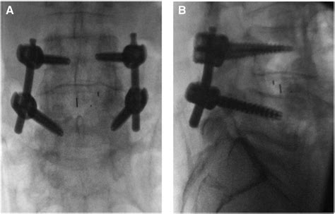 Intraoperative Anteroposterior A And Lateral B Fluoroscopic Images