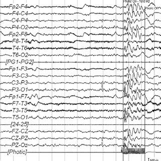 Awake EEG Bilateral And Asynchronous Spike And Spike And Wave