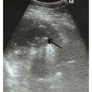 CT scan showing a retroperitoneal abscess (arrow) due to retained... | Download Scientific Diagram