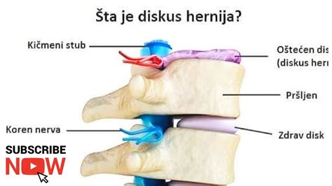 Diskus Hernija Lecenje Bez Operacije Zivot Bez Bola Discus Herniation