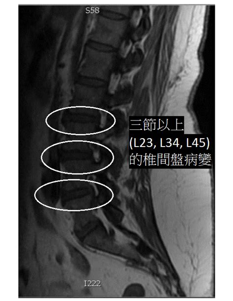 生昇診所 文獻回顧 ： 羊膜絨毛膜衍生物 Amniofix® 椎間盤內注射的效果如何？