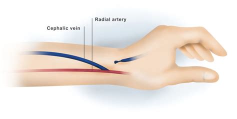 Dialysis Access Surgery Dr Ahmed Farah Abdulrahman