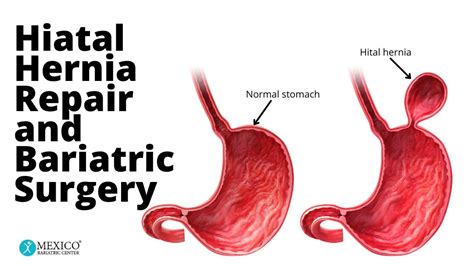 Hiatal Hernia