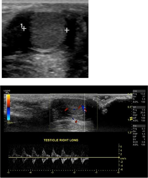 Ultrasound With Doppler Of Right Testicle Demonstrating Normal Size And