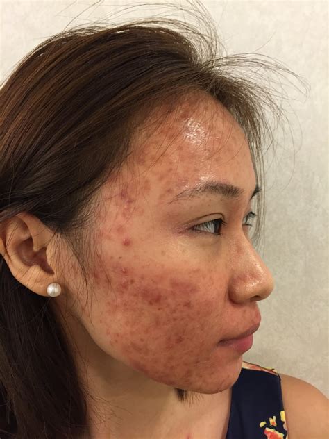 Dr Gerard Ee Clifford Agnes And Q Switch Laser The Treatment For Acne Pimples