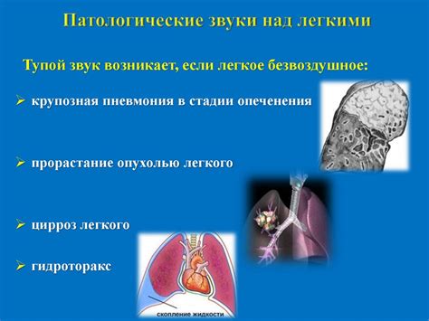 Сравнительная перкуссия лёгких - презентация онлайн