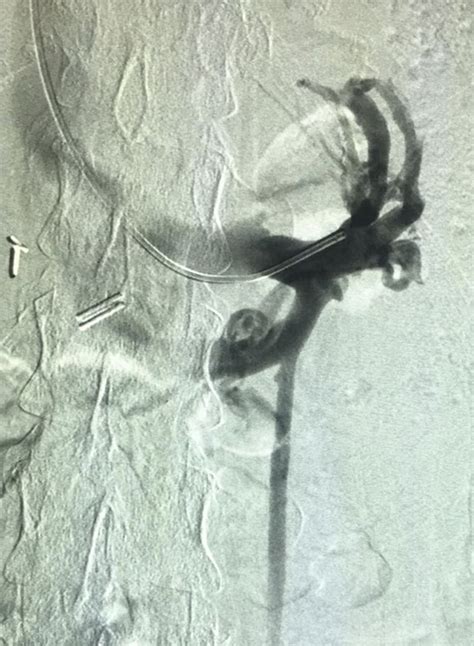 Endovascular Treatment Of Anterior Nutcracker Syndrome And Pelvic