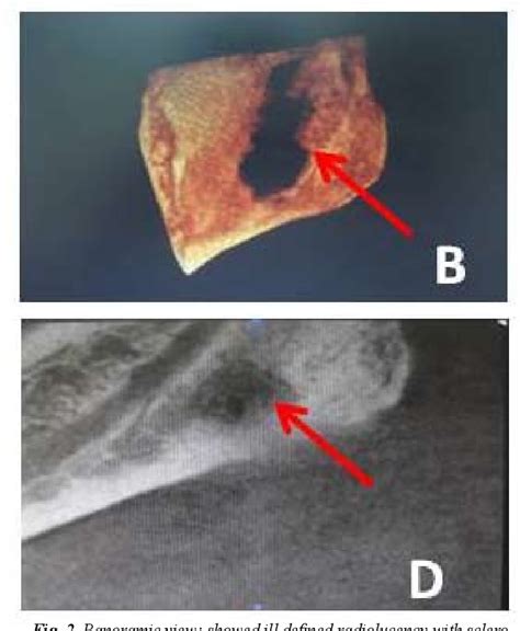 Figure 1 From Osteomyelitis Affecting Mandible In Tuberculosis Patients Semantic Scholar