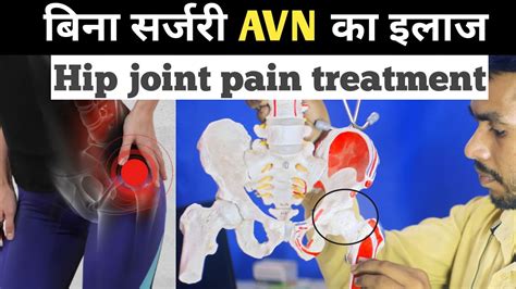 Avn Hip Treatment Without Surgery Hip Joint Pain Relief Exercises