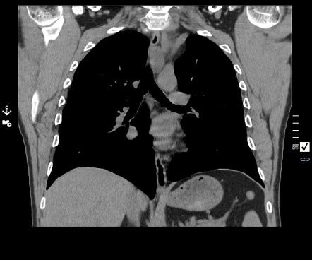 Vagus And Recurrent Nerve Schwannomas Image Radiopaedia Org