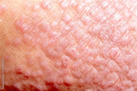 Atopic Dermatitis Ad Also Known As Atopic Eczema Is A Type Of