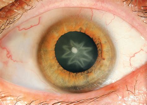 Cataracts: Symptoms and Treatment | Live Science