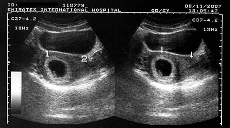 Ultrasound Images of Early Pregnancy