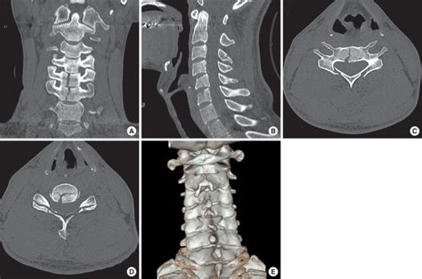 Cervical Spine Computed Tomographic Ct Scans With 3 Dimensional 3 D Download Scientific