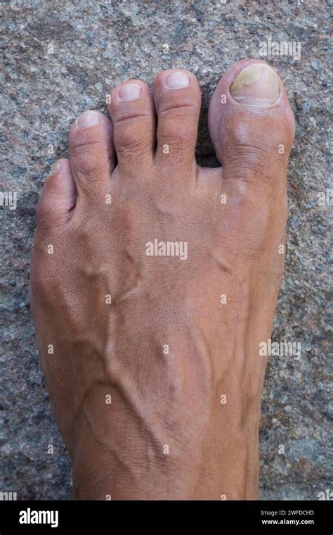 Toenails With Fungus Problems Onychomycosis Also Known As Tinea