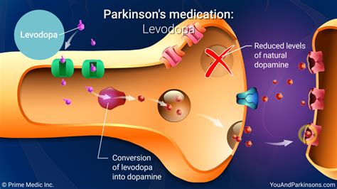 Slide Show Treatment And Management Of Parkinsons Disease