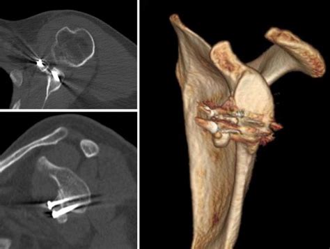 Failed Latarjet Procedure Ct Axial A Sagittal B And 3d