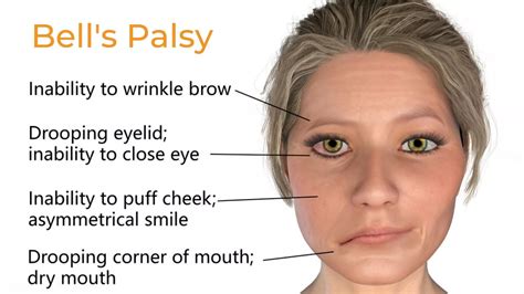 Bells Palsy What It Is Causes Symptoms And Treatment Healthy Nation