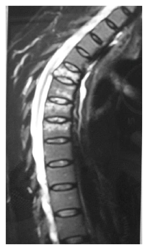 T1 Weighted And T2 Weighted Sagittal Magnetic Resonance Imaging MRI