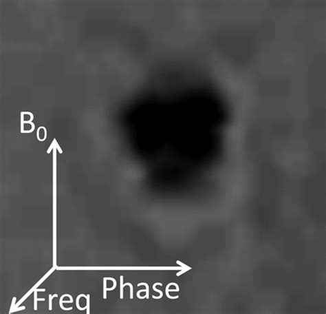 Comparison Of The Artifacts Caused By Metallic Implants In Breast Mri