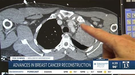 Advances in breast cancer reconstructive surgery