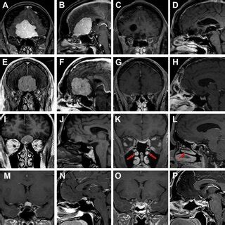 Endoscopic Intraoperative Images Of Case A B And Case C D A