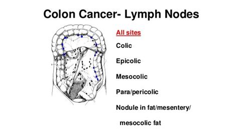 Colorectal Carcinoma Anatomy To Management