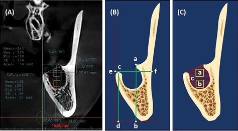 Frontiers Alveolar Ridge Preservation In Post Extraction Sockets