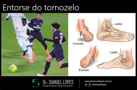 Saiba Mais Sobre A Entorse Do Tornozelo Dr Samuel Lopes