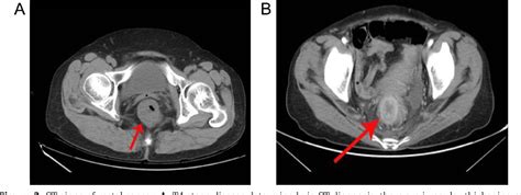 Figure From Ultrasound Ct Combined With Serum Cea Ca In The