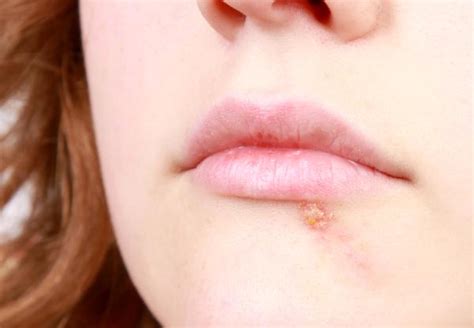 Por Qué Sale El Herpes Labial 6 Pasos