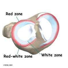 47 best Orthopedic Injury of the Knee images on Pinterest | Knee surgery, Acl and Anatomy