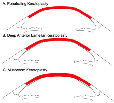 Schematic diagram of penetrating keratoplasty (A), deep anterior ...