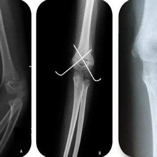 A Pre Op X Ray B Immediate Post Op X Ray Showing Lateral Pin