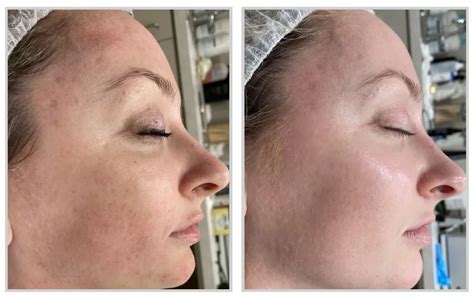 Bbl Hero Moxi Combination Treatment To Treat Hyperpigmentation Melasma